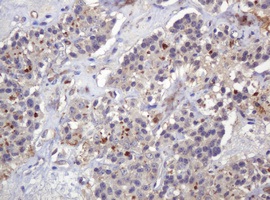 Immunohistochemical analysis of paraffin embedded Human pancreas carcinoma tissue labelling PARVB with ab140384 at 1/150 dilution.