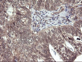 Immunohistochemical analysis of paraffin-embedded Human breast adenocarcinoma tissue labelling Parvin alpha with ab140960 at 1/150 dilution.