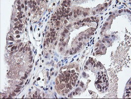 Immunohistochemical analysis of paraffin-embedded Human ovary adenocarcinoma tissue labelling Parvin alpha with ab140960 at 1/150 dilution.