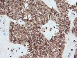 Immunohistochemical analysis of paraffin-embedded Human pancreas carcinoma tissue labelling Parvin alpha with ab140502 at 1/150 dilution.