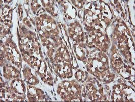 Immunohistochemical analysis of paraffin-embedded Human thyroid carcinoma tissue labelling Parvin alpha with ab140502 at 1/150 dilution.