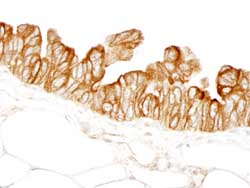 Detection of human HPIP by immunohistochemistry on formalin fixed, paraffin embedded sections of human ovarian carcinoma, using ab84752 at a 1/100 dilution. Detection: DAB staining.