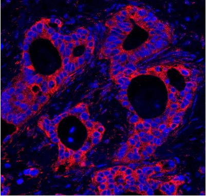 Detection of human HPIP by immunohistochemistry immunofluorescence of human ovarian carcinoma, using ab84752 at 1/100 dilution. Detection: red fluorescent Goat anti-Rabbit IgG diluted 1/100.