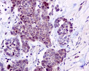 Immunohistochemical analysis of paraffin-embedded Human ovarian carcinoma tissue labeling NMD3 with ab170898 at 1/50 dilution.