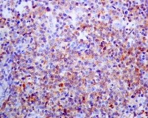 Immunohistochemical analysis of paraffin embedded Human T-cell lymphoma tissue labelling PD1 using ab137132 at a dilution of 1/250.