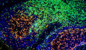 Double immunofluorescence staining of CD3 (green) and PD1 (red) on paraffin embedded tonsil.