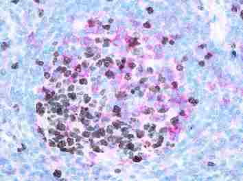 Double immunoenzymatic staining of Ki67 (brown) and PD1 (red) on paraffin embedded tonsil.
