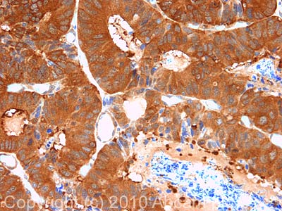 IHC image of ab75430 staining in Human Colon cancer formalin fixed paraffin embedded tissue section, performed on a Leica BondTM system using the standard protocol F. The section was pre-treated using heat mediated antigen retrieval with sodium citrate buffer (pH6, epitope retrieval solution 1) for 20 mins. The section was then incubated with ab75430, 1µg/ml, for 15 mins at room temperature and detected using an HRP conjugated compact polymer system. DAB was used as the chromogen. The section was then counterstained with haematoxylin and mounted with DPX. For other IHC staining systems (automated and non-automated) customers should optimize variable parameters such as antigen retrieval conditions, primary antibody concentration and antibody incubation times.