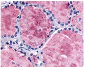 Immunohistochemistry analysis of human Thyroid tissue (Formalin-Fixed Paraffin-Embedded) using ab61817 at 5&microg/ml. Detection was done with biotinylated goat anti-rabbit IgG secondary antibody, alkaline phosphatase-streptavidin, and chromogen.