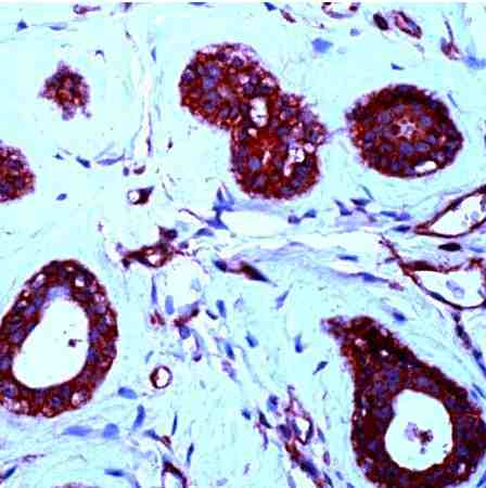 Formalin fixed paraffin embedded human angiosarcoma stained with PDGF B using ABC and AEC chromogen.