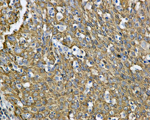 Immunohistochemical analysis of paraffin-embedded Human cervical carcinoma tissue labeling PDZRN4 with ab171083 at 1/50 dilution.