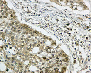 Immunohistochemical analysis of paraffin-embedded Human lung carcinoma tissue labeling PDZRN4 with ab171083 at 1/50 dilution.