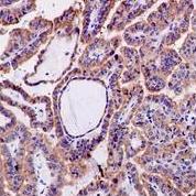 ab126610, at 1/50 dilution, staining PEAMT in Formalin-fixed, Paraffin-embedded Human papillary adenocarcinoma tissue by Immunohistochemistry.