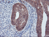 ab128484 at 1/150 dilution staining PECR in paraffin-embedded Human endometrium adenocarcinoma tissue by immunohistochemistry.