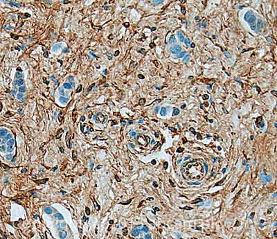 IHC image of Periostin staining in Human breast fibroadenocarcinoma formalin fixed paraffin embedded tissue section, performed on a Leica BondTM system using the standard protocol F. The section was pre-treated using heat mediated antigen retrieval with sodium citrate buffer (pH6, epitope retrieval solution 1) for 20 mins. The section was then incubated with ab79946, 0.1µg/ml, for 15 mins at room temperature and detected using an HRP conjugated compact polymer system. DAB was used as the chromogen. The section was then counterstained with haematoxylin and mounted with DPX.For other IHC staining systems (automated and non-automated) customers should optimize variable parameters such as antigen retrieval conditions, primary antibody concentration and antibody incubation times.