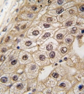 Formalin fixed and paraffin embedded human hepatocarcinoma tissue labelled with ab77654 (at a 1/50 dilution), which was peroxidase conjugated to the secondary antibody, followed by DAB staining.