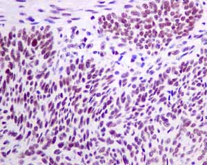 Immunohistochemical analysis of paraffin embedded Human Cervical carcinoma tissue using ab140634 showing +ve staining.