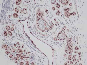 ab9585 at 0.25 µg/ml staining human breast invasive ductal carcinoma tissue by IHC-P.  The antibody was incubated for two hours at room temperature.  An HRP-labeled polymer detection system was used with DAB chromogen. Heat induced antigen retrieval was performed with a pH 6.0 Sodium Citrate buffer.