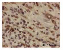 ab15537 at 1/200 staining human anal cancer tissue sections by IHC-P. The tissue was formaldehyde fixed and a heat mediated antigen retrieval step in citrate buffer was performed before incubation with the antibody for 30 minutes. An HRP conjugated goat anti-rabbit antibody was used as the secondary.See Abreview