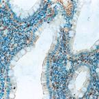 Human colon, ulcerative colitis: IHC-P staining for transforming growth factor beta receptor (type 1) using ab49575. Membrane staining of a proportion of epithelial cells and lymphocytes.