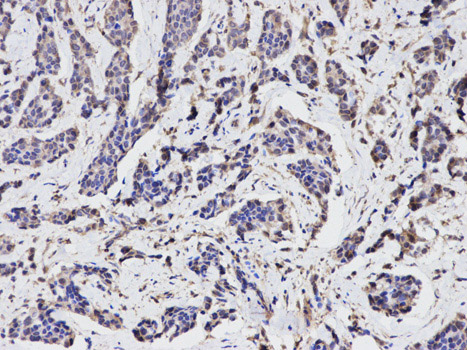 Immunohistochemistry (Formalin/PFA-fixed paraffin-embedded sections) analysis of human breast cancer tissue labelling TGFBI with ab189778 at 1/100. Magnification: 200x.