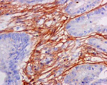 Immunohistochemical analysis of paraffin-embedded Human colon adenocarcinoma tissue labeling TGFBI with ab169771 at 1/250 dilution.