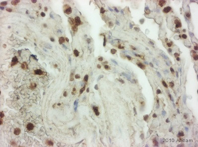 ab26320 staining Thioredoxin/TRX in Human lung tissue sections by IHC-P (Formaldehyde-fixed, paraffin-embedded sections). Tissue was fixed with formaldehyde and blocked with 5 minutes of peroxidase block followed by 10 minutes of protein block at 20°C; antigen retrieval was heat mediated in retrieval solution. Samples were incubated with primary antibody (1/2000 in antibody diluent) for 45 minutes at 20°C. An undiluted HRP-conjugated polymer goat anti-mouse/rabbit IgG polyclonal polymer was used as the secondary antibody.See Abreview