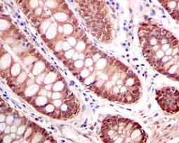 Immunohistochemistry analysis of Paraffin Embedded Human colon tissue labelling Thioredoxin/TRX with ab133524 at 1/250.