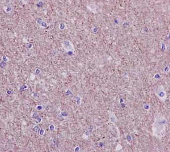 Immunohistochemical analysis of paraffin-embedded Human astocytoma tissue labeling Thioredoxin domain containing 9 with ab185959 at 1/50 dilution followed by pre-diluted HRP-conjugated secondary antibody and counter-stained with Hematoxylin.