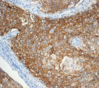 ab109189, at 1/100 dilution, staining Thrombomodulin in Human squamous cervical carcinoma tissue by Immunohistochemistry.