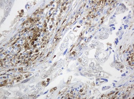 Immunohistochemical analysis of paraffin embedded Human breast adenocarcinoma tissue labelling Thymidine Phosphorylase with ab140786 at a 1/150 dilution.
