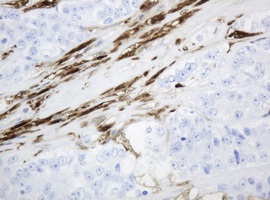 Immunohistochemical analysis of paraffin embedded Human colon adenocarcinoma tissue labelling Thymidine Phosphorylase with ab140786 at a 1/150 dilution.
