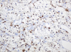 Immunohistochemical analysis of paraffin embedded Human kidney carcinoma tissue labelling Thymidine Phosphorylase with ab140786 at a 1/150 dilution.