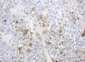 Immunohistochemical analysis of paraffin embedded Human liver carcinoma tissue labelling Thymidine Phosphorylase with ab140786 at a 1/150 dilution. 