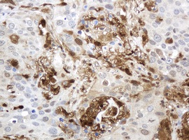 Immunohistochemical analysis of paraffin embedded Human lung carcinoma tissue labelling Thymidine Phosphorylase with ab140786 at a 1/150 dilution. 