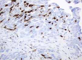 Immunohistochemical analysis of paraffin embedded Human ovary adenocarcinoma tissue labelling Thymidine Phosphorylase with ab140786 at a 1/150 dilution. 