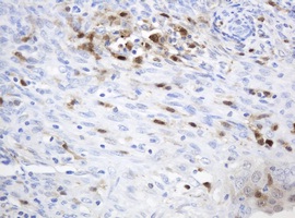Immunohistochemical analysis of paraffin embedded Human endometrium adenocarcinoma tissue labelling Thymidine Phosphorylase with ab140786 at a 1/150 dilution. 