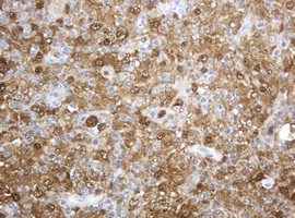 Immunohistochemical analysis of paraffin embedded Human lymphoma tissue labelling Thymidine Phosphorylase with ab140786 at a 1/150 dilution. 