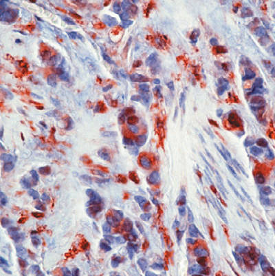 Immunohistochemical analysis of formalin-fixed, paraffin-embedded Human breast carcinoma tissue labelling Thymidine Phosphorylase with ab140246.