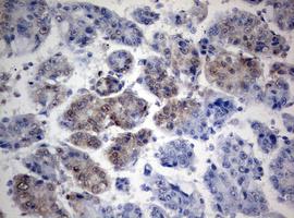 Immunohistochemical analysis of paraffin-embedded Human liver carcinoma tissue labeling TIA1 with ab170156 at 1/150 dilution.