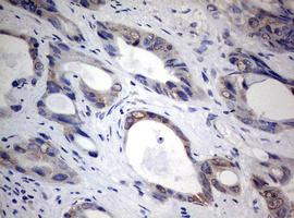 Immunohistochemical analysis of paraffin-embedded Human colon carcinoma tissue labeling TIA1 with ab170156 at 1/150 dilution.