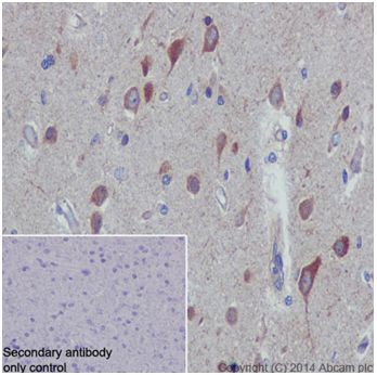 Immunohistochemical analysis of paraffin-embedded Human gliocytoma tissue labeling TIAM2 with ab199426 at 1/500 dilution followed by Goat Anti-Rabbit IgG H&L (HRP) (ab97051) at 1/500 dilution. Cytoplasm staining on Human gliocytoma tissue is observed. Counter stained with Hematoxylin.Negative control: Used only secondary antibody.