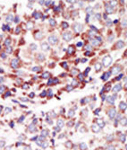 Immunohistochemical analysis of Formalin-fixed, Paraffin-embedded Human hepatocarcinoma tissue labelling TIE2 with ab135671 at 1/50 dilution followed by peroxidase-conjugated secondary antibody and AEC staining.