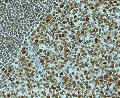 IHC image of ab72458 staining Timeless in Human Tonsil formalin fixed paraffin embedded tissue section, performed on a Leica BondTM system using the standard protocol F. The section was pre-treated using heat mediated antigen retrieval with sodium citrate buffer (pH6, epitope retrieval solution 1) for 20 mins. The section was then incubated with ab72458, 1µg/ml, for 15 mins at room temperature and detected using an HRP conjugated compact polymer system. DAB was used as the chromogen. The section was then counterstained with haematoxylin and mounted with DPX.For other IHC staining systems (automated and non-automated) customers should optimize variable parameters such as antigen retrieval conditions, primary antibody concentration and antibody incubation times.
