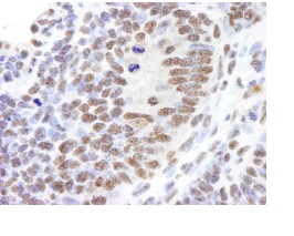 Staining of Timeless by Immunohistochemistry on a formalin fixed, paraffin embedded section of mouse teratoma using a 1/250 dilution of ab84502. Detection: DAB staining.