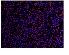 Staining of Timeless by Immunofluorescence on a formalin fixed, paraffin embedded section of human breast carcinoma using a 1/100 dilution of ab84502. Detection: Red-fluorescent Alexa Fluor 555 goat anti rabbit IgG.