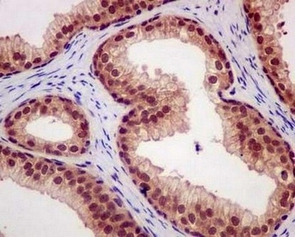 Immunohistochemical analysis of paraffin-embedded Human prostatic hyperplasia tissue labeling TIP120A with ab181216 at 1/100 dilution followed by pre-diluted HRP-conjugated secondary antibody and counter-stained with Hematoxylin.