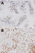 Immunohistochemistry analysis of TLR4 in formalin-fixed, paraffin-embedded normal (a) and tumor (b) prostate sections using ab47093 at 1:50 dilution. Data courtesy of Dr. Regina Gandour-Edwards. 