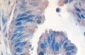 Immunohistochemical analysis of TLR9 in frozen sections of Human lung adenocarcinoma tissue, using ab134368 at a 1/100 dilution.