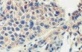 Immunohistochemical analysis of TLR9 in frozen sections of malignant Human lung tissue, using ab134368 at a 1/100 dilution.